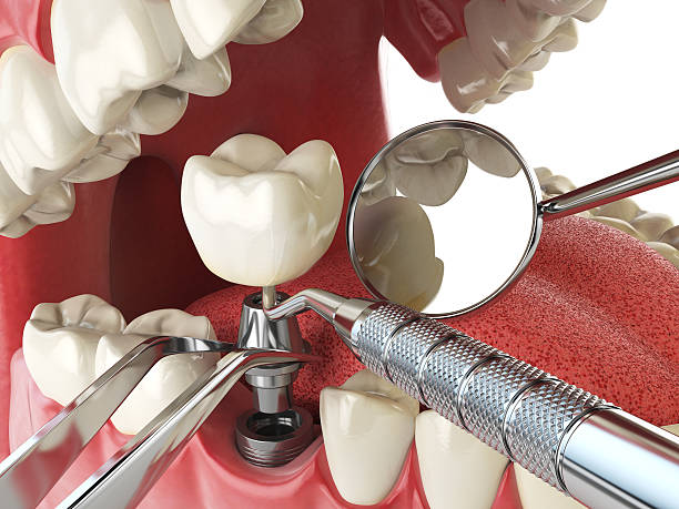 Best Emergency Dentist for Lost Fillings or Crowns in Chicago Heights, IL